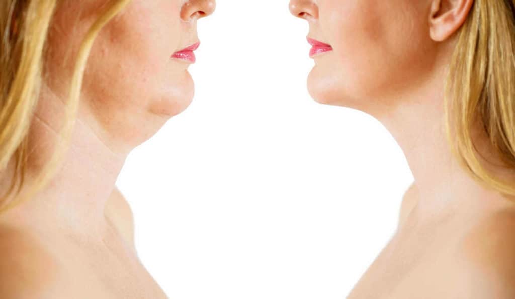 Double Chin treatment North Harrow before and after results