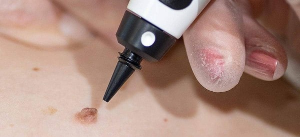 After Skin Tag Removal North Harrow
