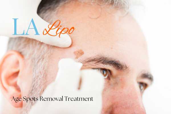 What Are the Most Effective Treatments for Age Spots North Harrow?