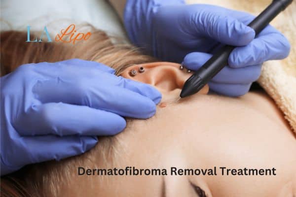Dermatofibroma Removal Treatment North Harrow