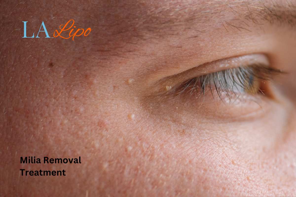 Cryopen Milia Removal: Is It the Easiest and Safest Option North Harrow?