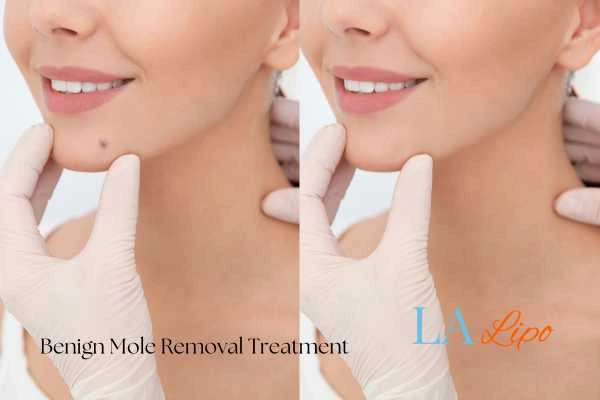 Before-and-after results following benign mole-removal treatment North Harrow