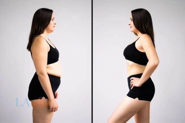 image of woman before and after results of LA-EMS Body Sculpting North Harrow to help treat Diastasis recti