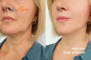 hi-fu for wrinkles North Harrow before and after results