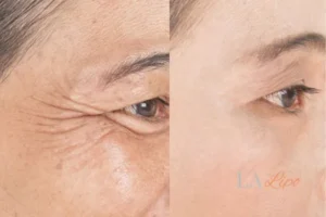 Before and after results of woman - HI-fu wrinkles reduction treatment North Harrow