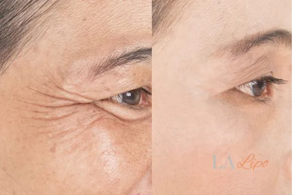 Before and after results of woman - HI-fu wrinkles reduction treatment North Harrow