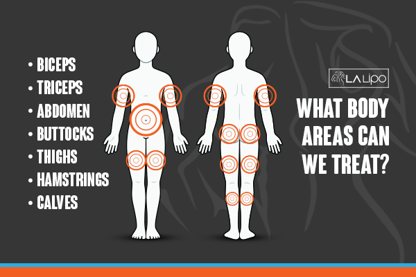 Graphic to show areas you can have LA-EMS Body Sculpting North Harrow treatment.