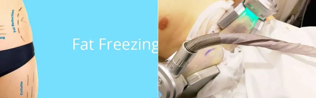 Fat freezing North Harrow on multiple areas of the body