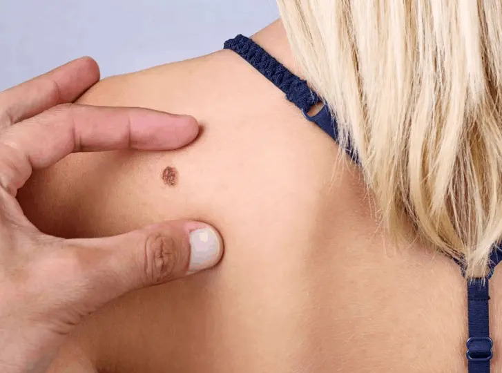 woman having mole removal North Harrow consultation before treatment.