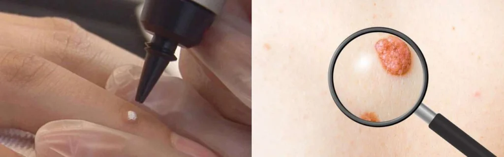 CryoPen practitioner North Harrow assessing a benign mole before treatment