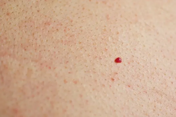 close up of a cherry angioma North Harrow