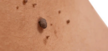 image of a skin tag North Harrow