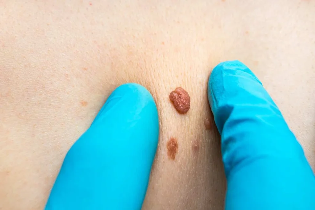 Consultant examining a skin tag North Harrow