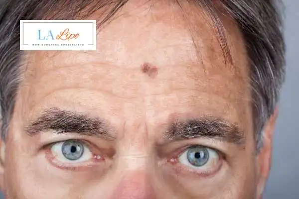 Solar Lentigo Removal North Harrow image of man with mark on his forehead