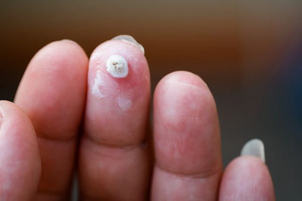 wart on person finger - cryotherapy to treat from LA LIPO North Harrow