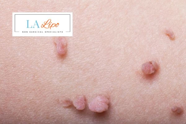 Does cryopen skin tag removal North Harrow hurt? Find out now call our team today!