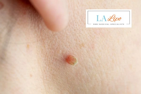 Book skin tag removal North Harrow today speak to our team now!