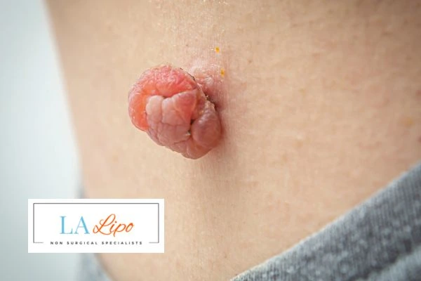 Interested in skin tag removal North Harrow? Concerned about the pain? Find out more today!