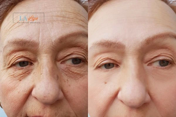 The powerful benefits of Morpheus8 Treatment North Harrow - Call Our team today!