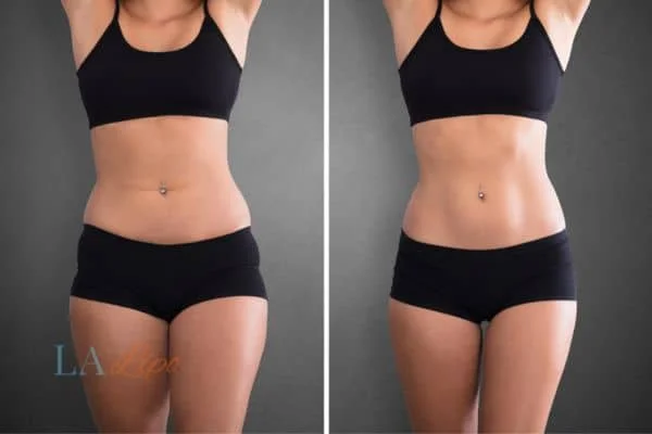 before and after results of non-surgical treatment to help a woman's body image and mental health North Harrow