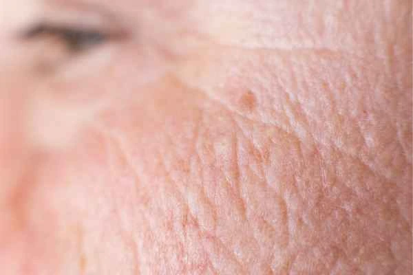 close up picture of a woman's face showing an age spot North Harrow