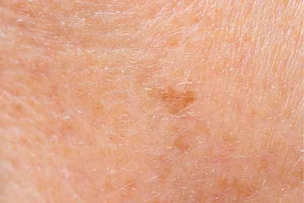 close up picture of age spots North Harrow
