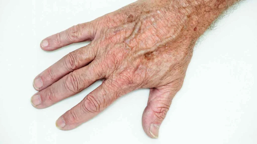Male hand showing age spot North Harrow