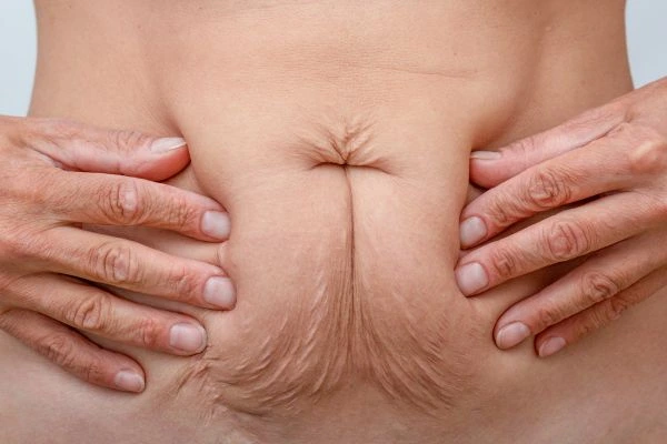 Image of a woman's stomach with loose skin - example of skin tightening North Harrow options